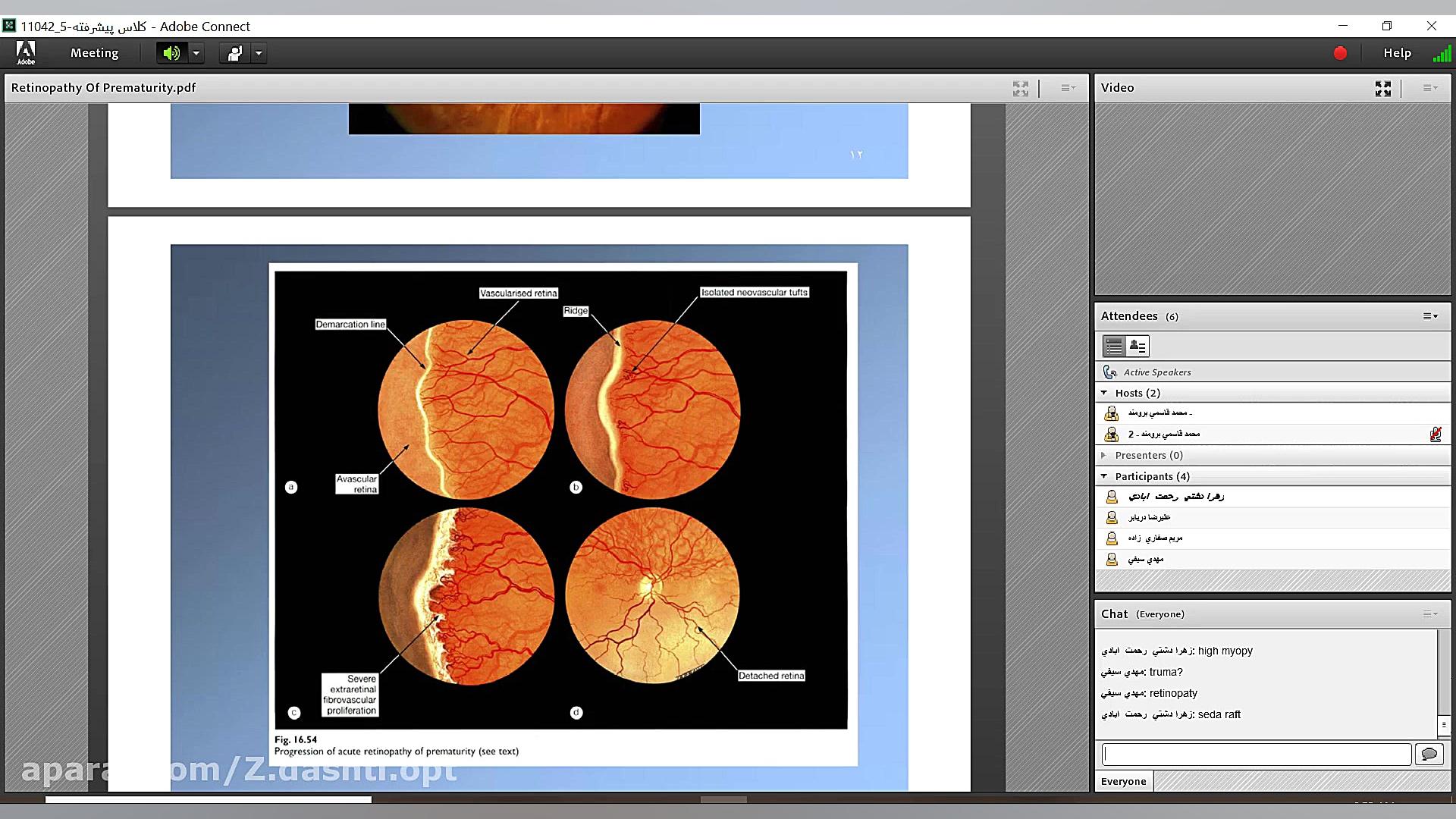 تومورهای چشمی.رتینوپاتی نوزادان.ROP.OCULAR TUMOR لیپوماتیک