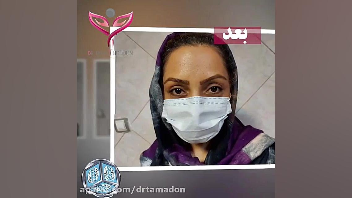 قبل و بعد از عمل جراحی پلک دندان پیش