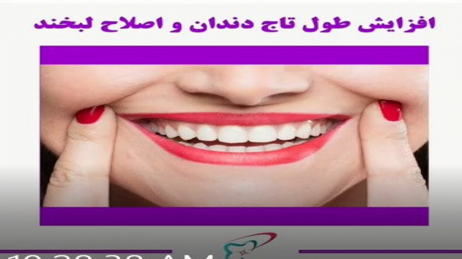 اصلاح طرح لبخند با افزایش طول تاج دندان در خانم جوان گلوسودینیا