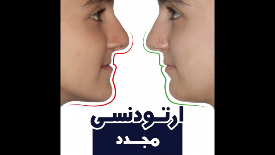 ارتودنسی مجدد | دکتر داودیان پر کردن دندان