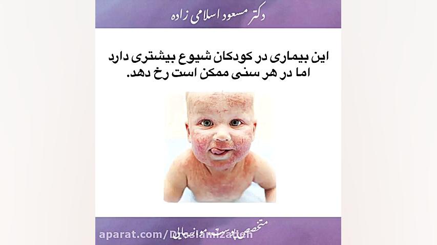 اگزما (درماتیت آتوپیک) برداشتن توده