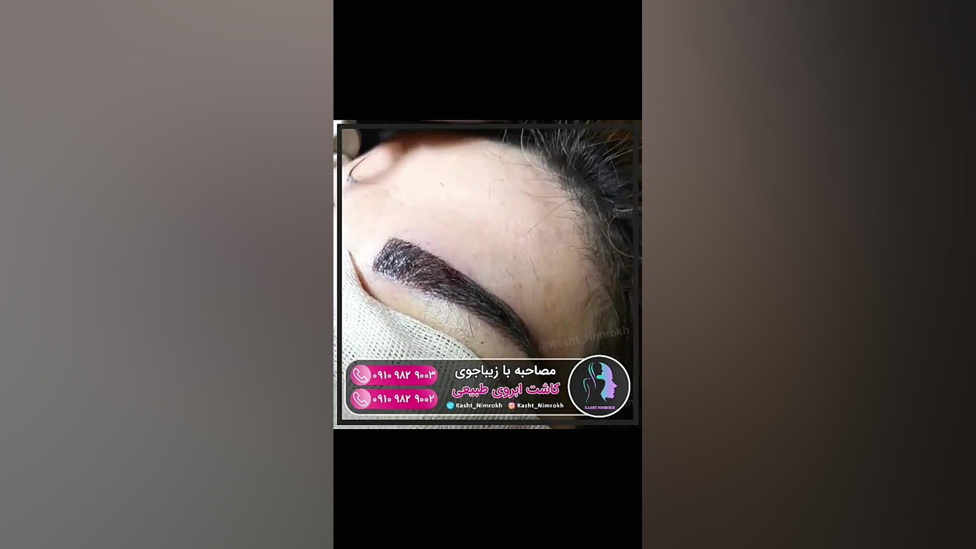 کاشت ابرو را از نزدیک ببینید! اولتراسوند پرتابل جیبی
