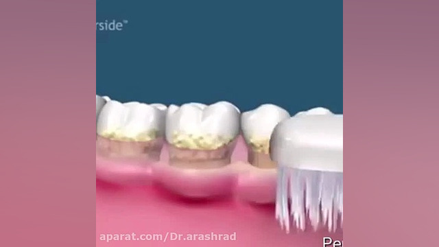 تاثیر جرم گیری بر سلامت لثه بیماری پورفیری اریتروپوئتیک