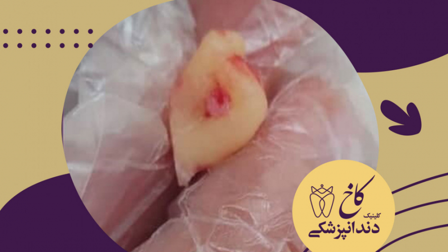 دندان شیری در بزرگسالی کلینیک دندانپزشکی کاخ