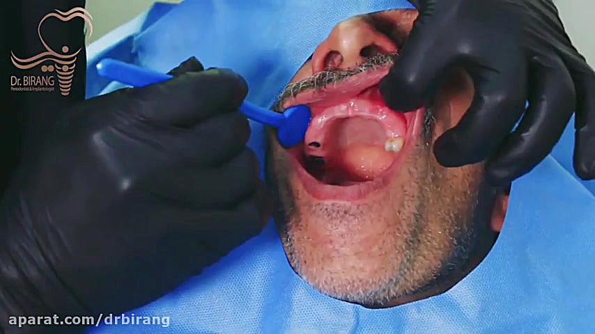 فیلم ایمپلنت دیجیتال تمام دهان همراه روکش فوری یک روزه دکتر احسان بیرنگ