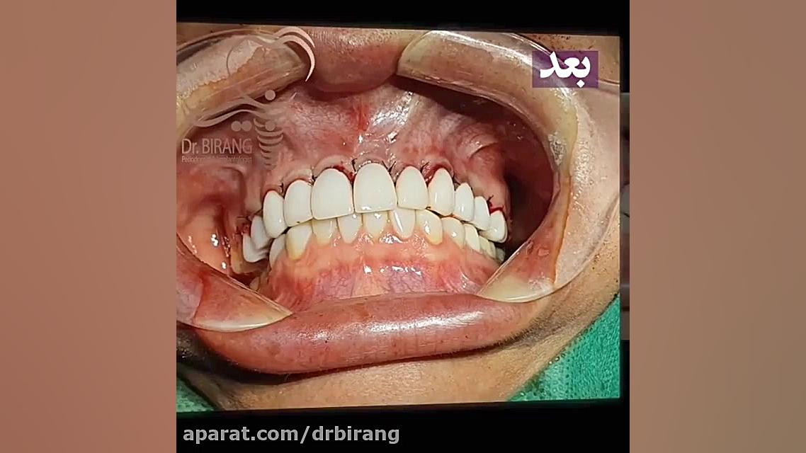 فیلم جراحی اصلاح عفونت لثه در اثر درمان نادرست لمینت سرامیکی دکتر احسان بیرنگ
