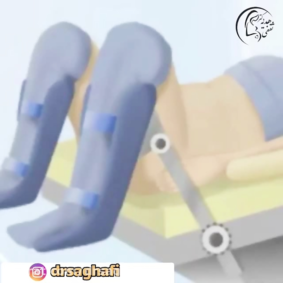 هیسترکتومی واژینال یا برداشتن رحم از واژن