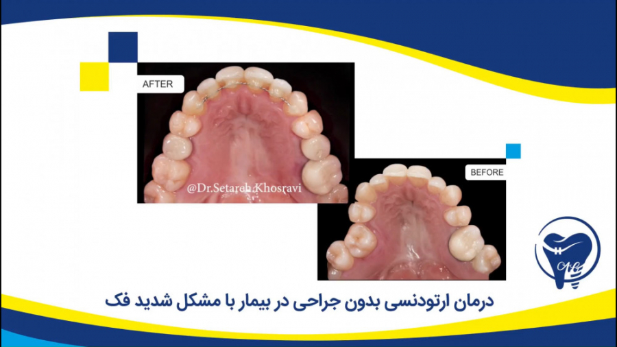 درمان ارتودنسی بدون جراحی در بیمار با مشکل شدید فک کلینیک دندانپزشکی دکتر عزیز گشاده رو