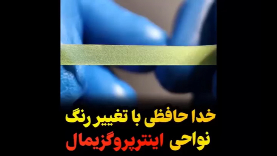 خداحافظی با تغییر رنگ نواحی اینتریروگزیمال جراحی پف زیر چشم