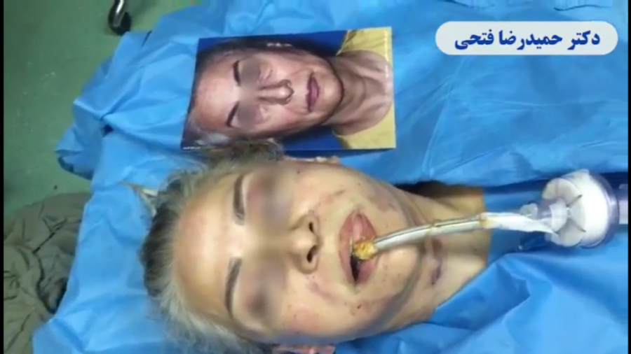 فیلم عمل جراحی لیفت صورت دکتر حمید رضا فتحی فوق تخصص جراحی پلاستیک