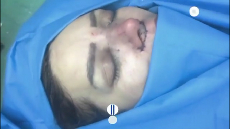 فیلم عمل لیفت لب و جراحی بینی دکتر حمید رضا فتحی فوق تخصص جراحی پلاستیک