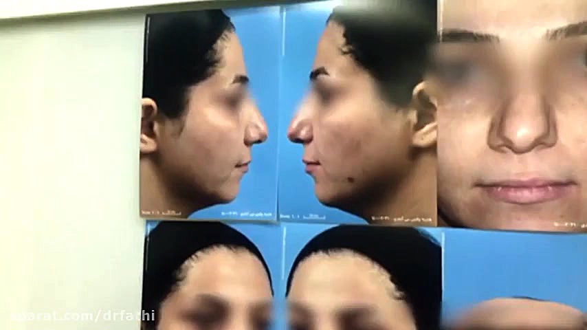 جراحی زیبایی چانه و بینی بلافاصله در اتاق عمل دکتر حمید رضا فتحی فوق تخصص جراحی پلاستیک