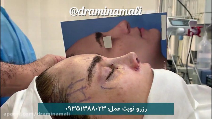 نمونه جراحی بینی و لیفت ابرو Organoid Viability Test