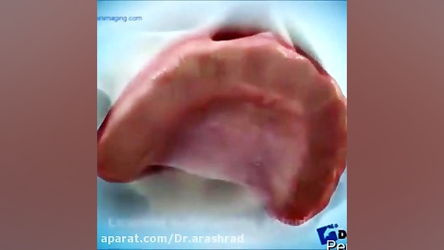 بازسازی بی دندانی کامل با پروتز ثابت متکی بر ایمپلنت رادیوگرافی دندان