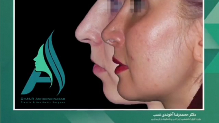 جراحی بینی همزمان با پروتز چانه و زاویه سازی فک دکتر محمدرضا آخوندی نسب-فوق تخصص جراحی پلاستیک