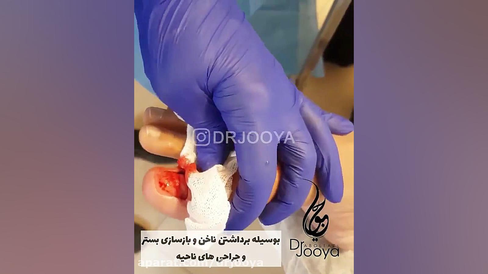 درمان ناخن فرورفته / دکتر جویا متخصص پوست اصفهان دکتر ابوالفضل جویا