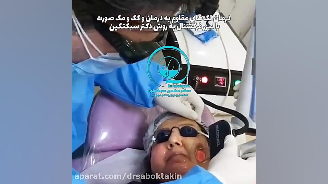 درمان تخصصی لکه های صورت با روش دکتر سبکتکین متخصص پوست اصفهان متخصص پوست اصفهان دکتر مهدی سبکتکین