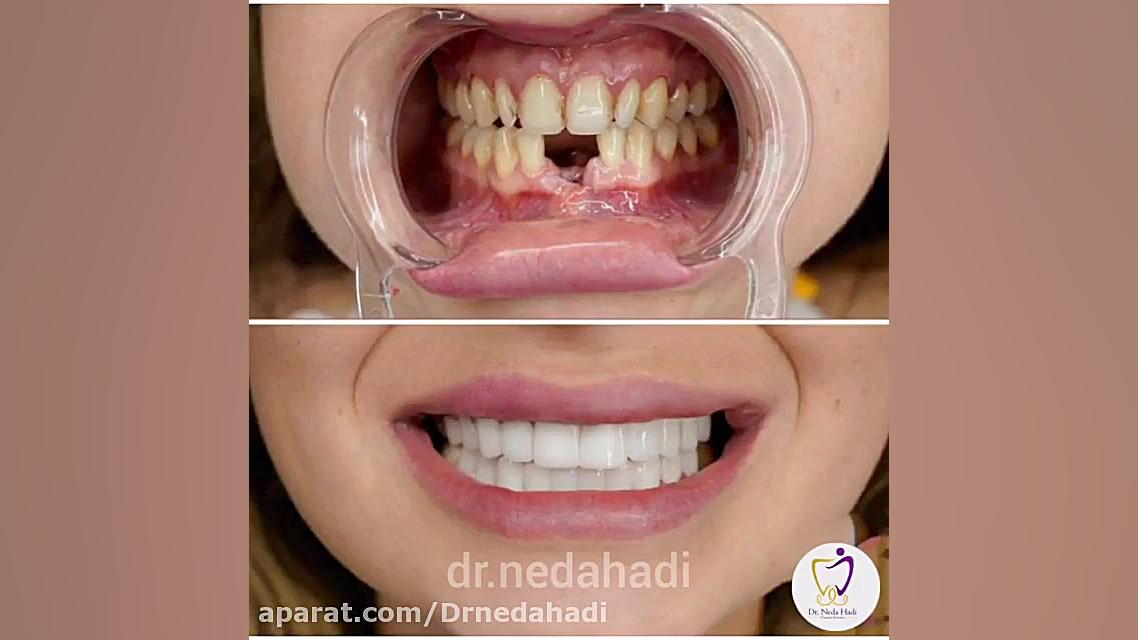 فیلم از درمان ترکیبی زیبایی روکش و لمینت دکتر ندا هادی-دندانپزشک زیبایی