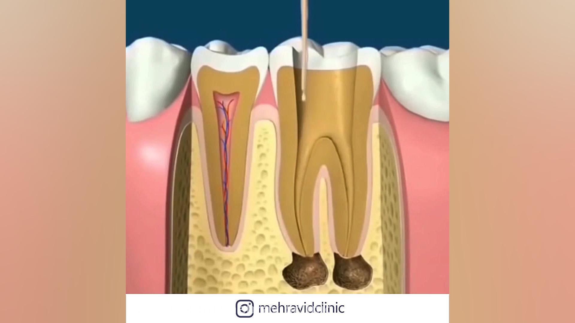 عصب کشی و روکش دستگاه آنالیز ایمیجینگ سلول زنده