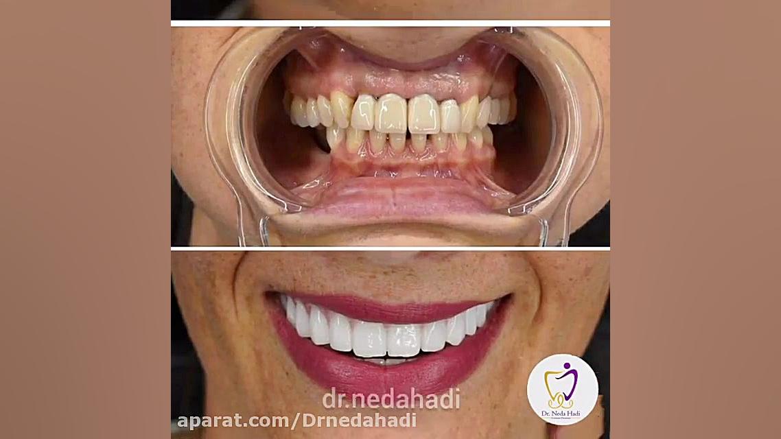 فیلم واقعی از لمینت دندان در مطب دکتر ندا هادی دکتر ندا هادی-دندانپزشک زیبایی