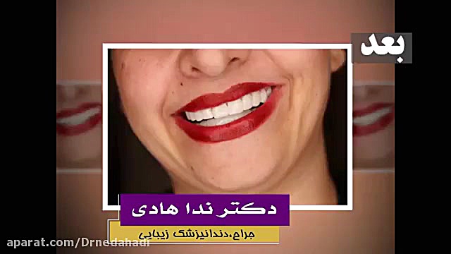 لمینت دندان چگونه انجام می شود؟ دکتر ندا هادی-دندانپزشک زیبایی