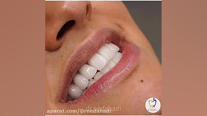 قبل و بعد کار زیبایی دندان در مطب دکتر ندا هادی دکتر ندا هادی-دندانپزشک زیبایی