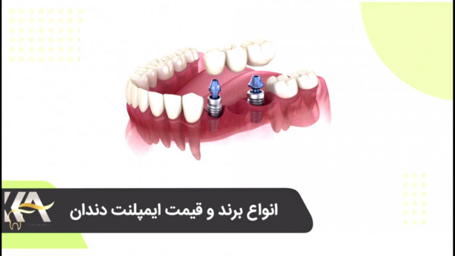 بهترین برند ایمپلنت کدامست؟ دکتر کامیار عباسی