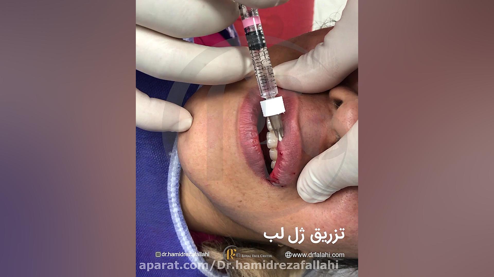 تزریق ژل لب دکتر حمیدرضا فلاحی