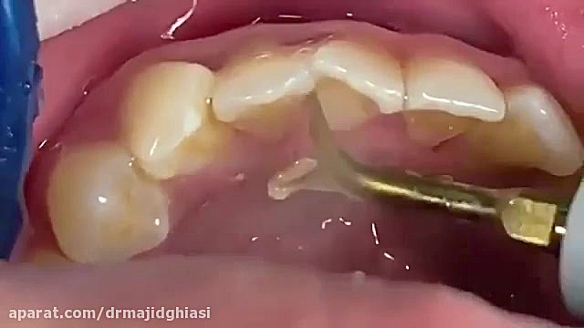 جرمگیری دندان بیماری بهجت