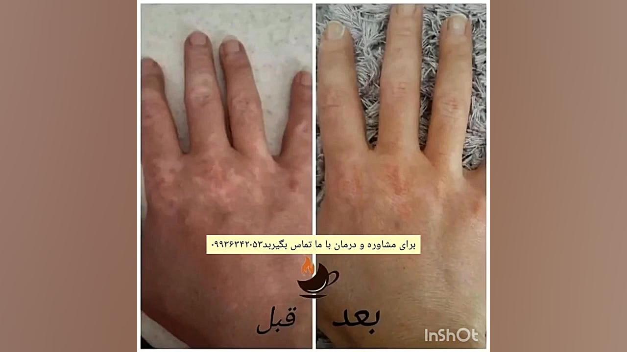 درمان و بهبود بیماری پوستی پیسی و ویتیلیگو و برص. تیلور سوئیفت