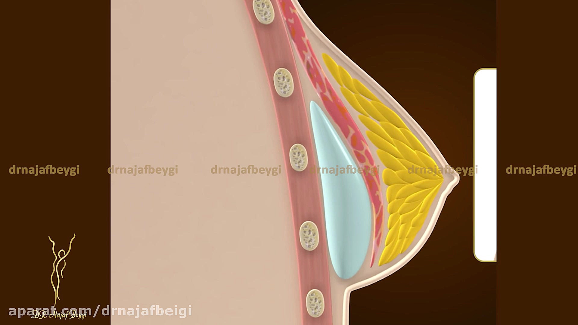 تفاوت محل قرار گیری پروتز سینه کاشت ابرو