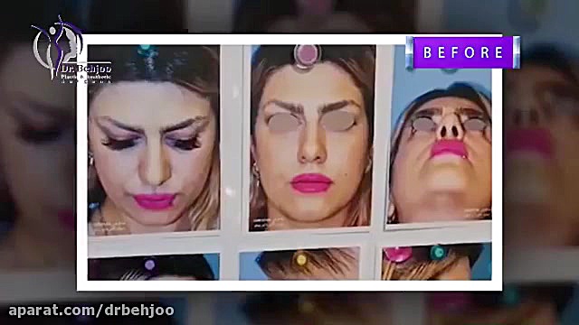 فیلم جراحى بينى همزمان با بوكال فت دکتر شاهین بهجو - فوق تخصص جراحی پلاستیک