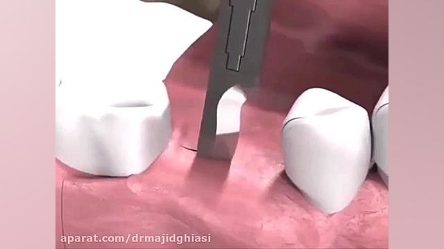 مراحل ایمپلنت دندان دکترمجیدقیاسی