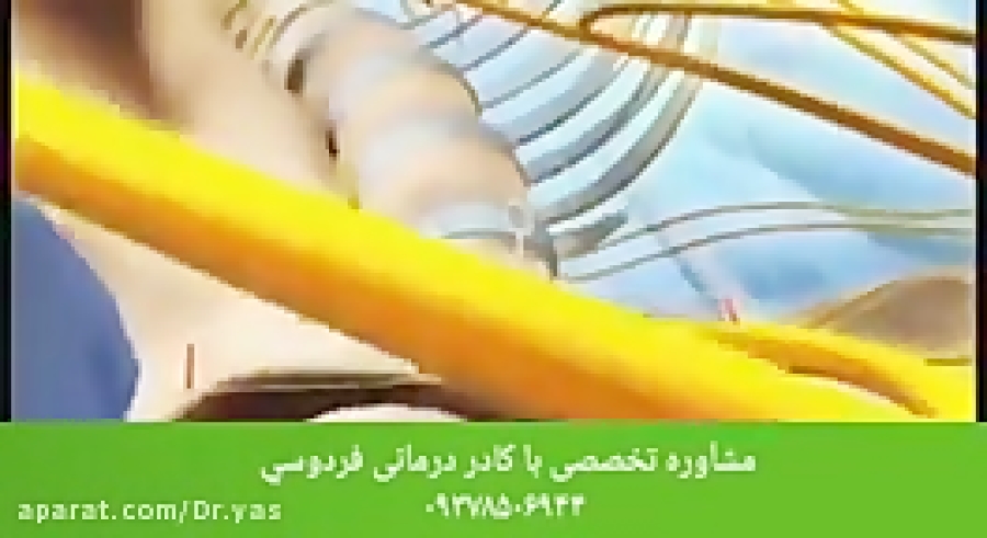 از راه های درمان دیسک کمر چه میدانید؟ از راه های درمان دیسک کمر چه میدانید؟