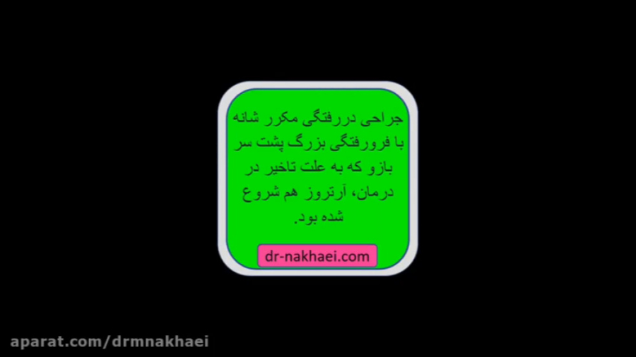 جراحی برای دررفتگی مکرر شانه با فرورفتگی بزرگ پشت سر بازو و شروع آرتروز پالپوتومی