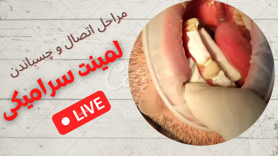 فرآیند چسباندن لمینت سرامیکی به دندان درمان جای جوش
