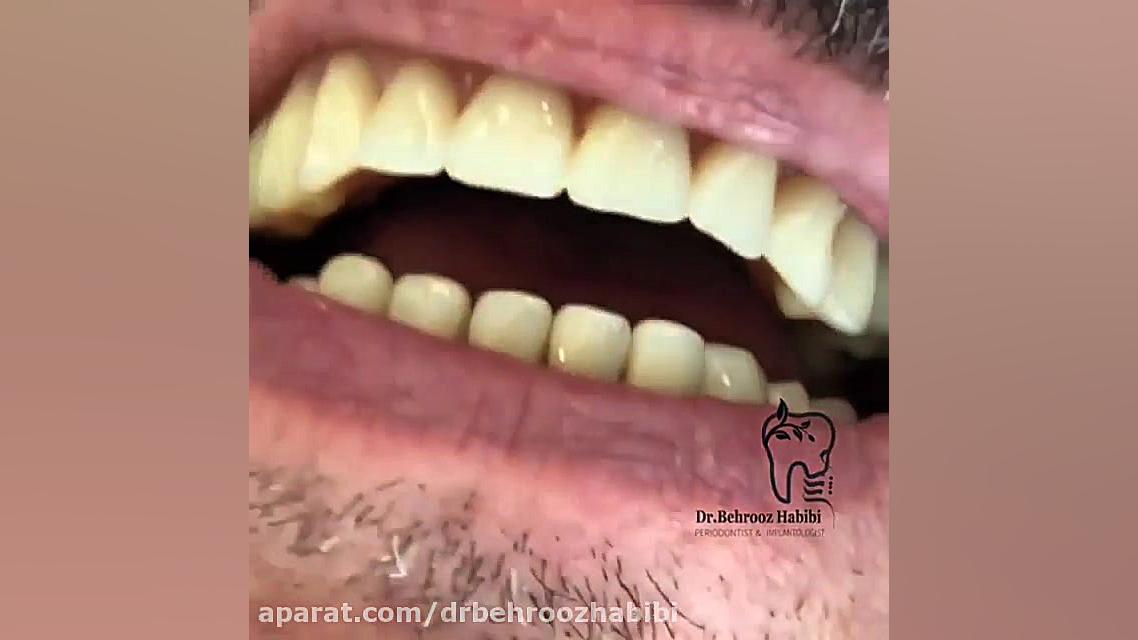اجرای ایمپلنت فک بالا دکتر بهروز حبیبی