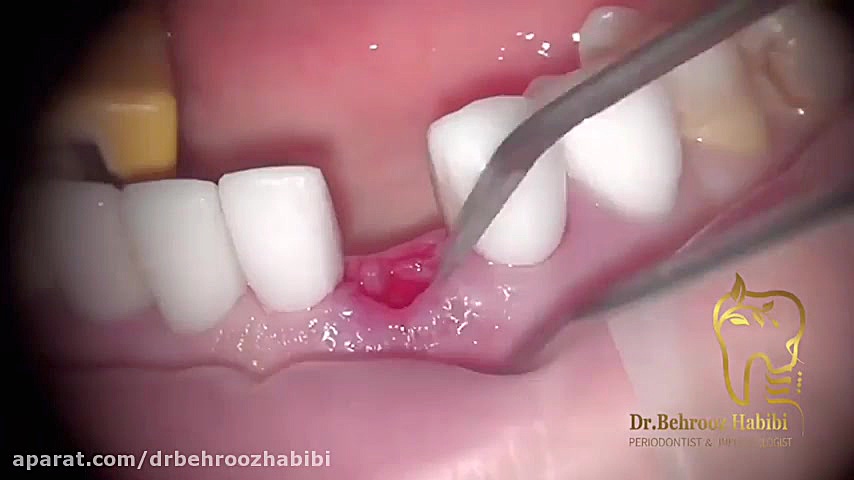 جراحی لثه و اجرای ایمپلنت دکتر بهروز حبیبی