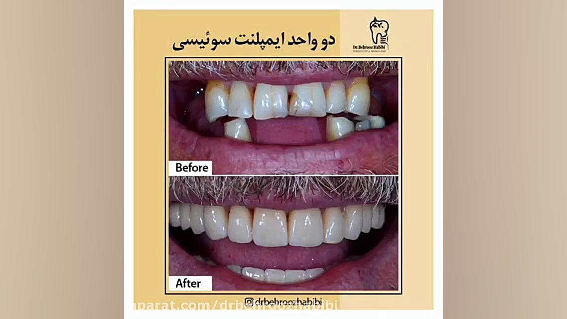 2 واحد ایمپلنت سوئیسی دکتر بهروز حبیبی