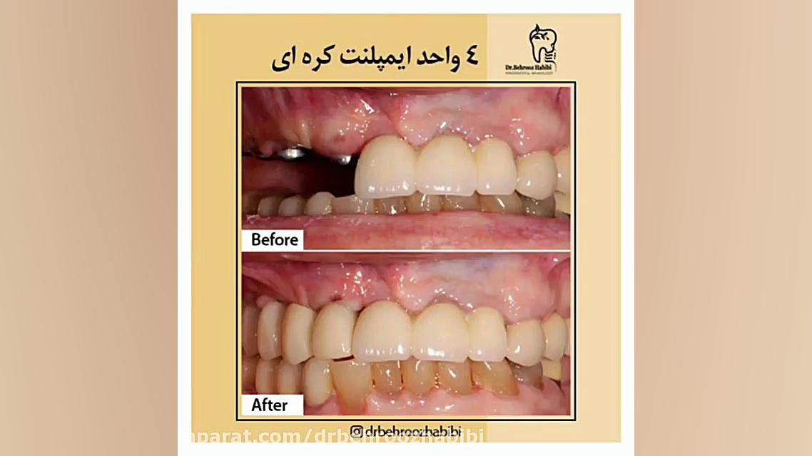 ۴ واحد ایمپلنت کره ای دکتر بهروز حبیبی