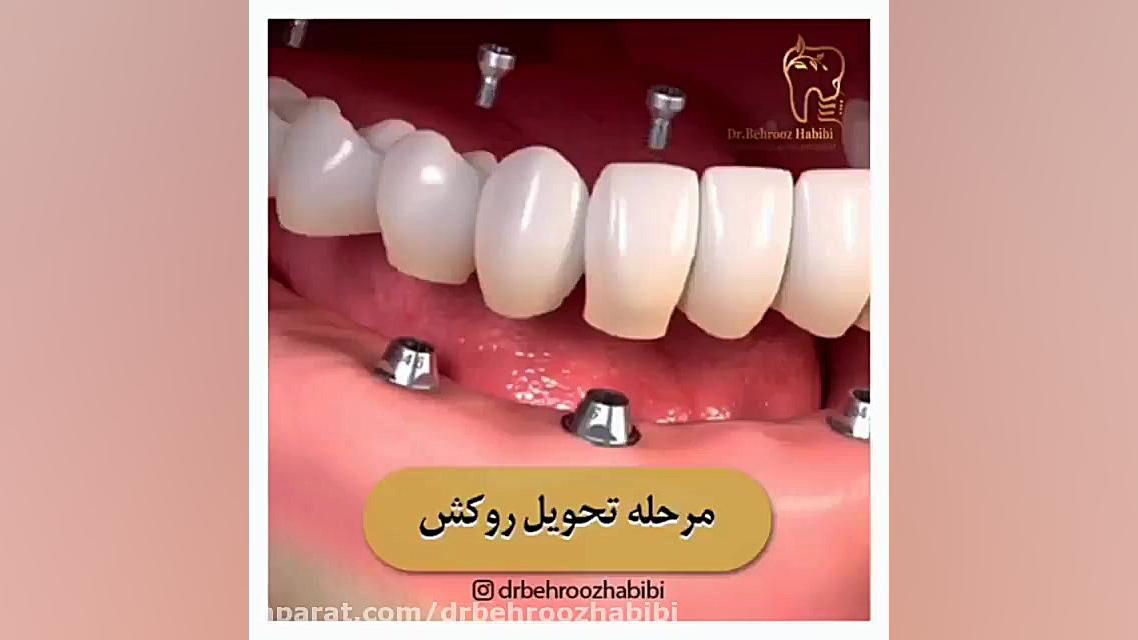مرحله تحویل روکش دکتر بهروز حبیبی