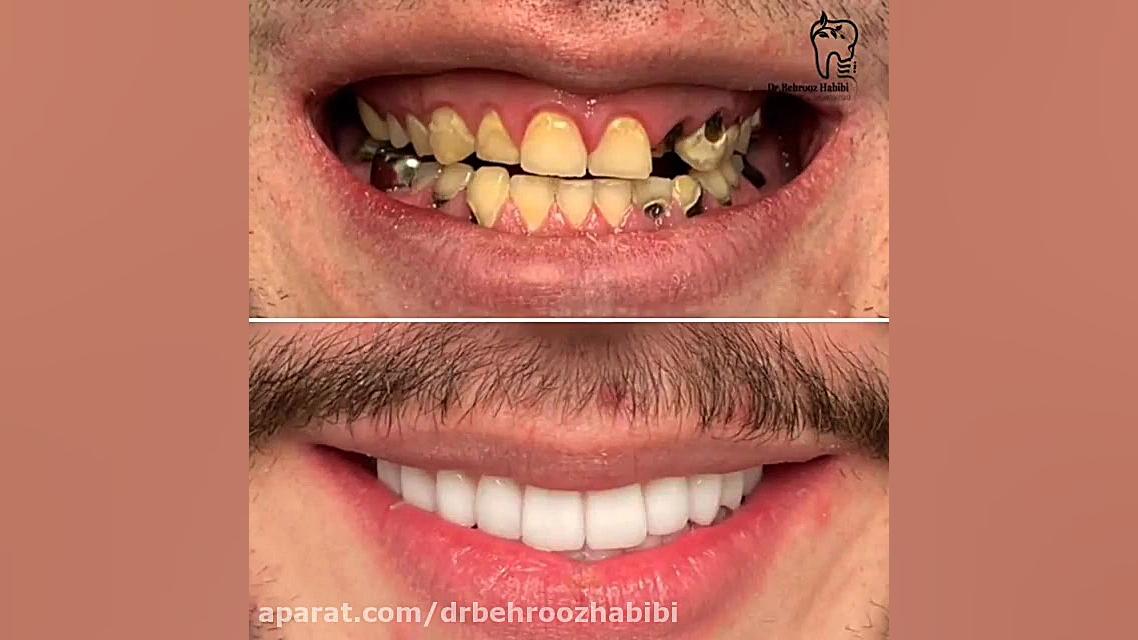 اصلاح لبخند با کاشت دندان دکتر بهروز حبیبی