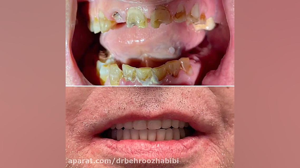 ایمپلنت دجیتال تهران دکتر بهروز حبیبی