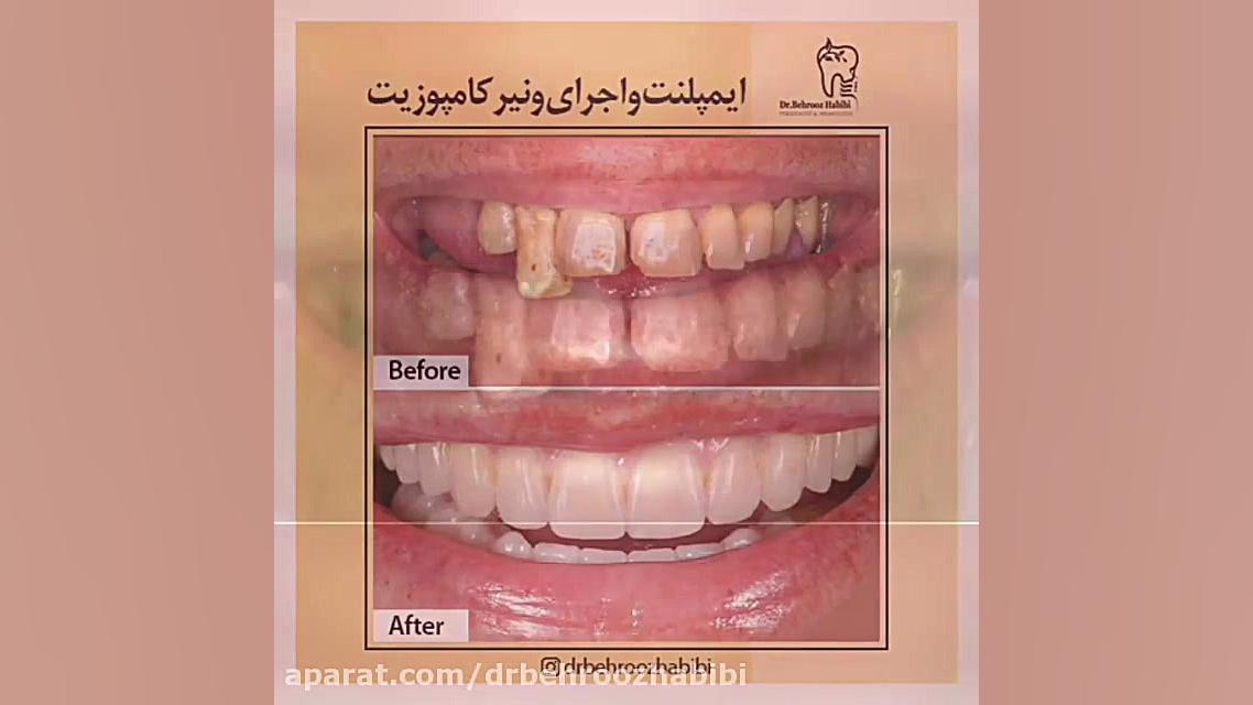 ایمپلنت و اجرای ونیر کامپوزیت کاشت مو
