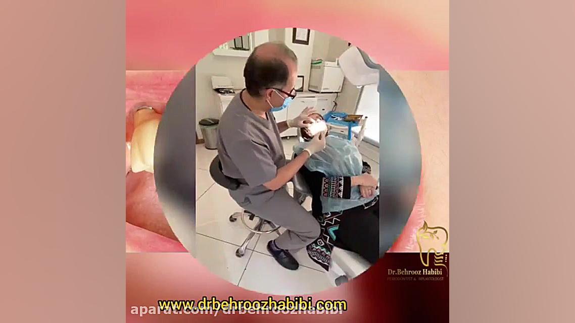 تحویل روکش ایمپلنت دکتر بهروز حبیبی