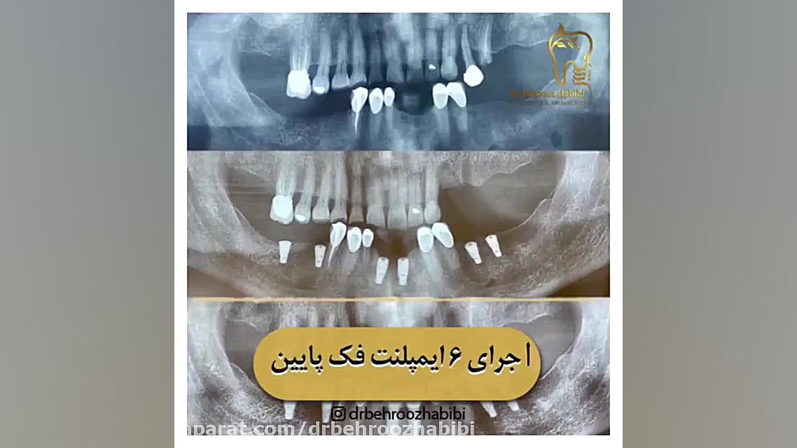 اجرای 6 واحد ایمپلنت فک پایین دکتر بهروز حبیبی