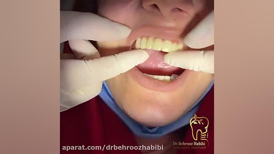 تحویل روکش ایمپلنت دکتر بهروز حبیبی
