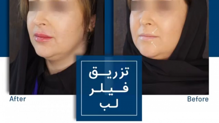 تزریق فیلر لب پان‌سیتوپنی