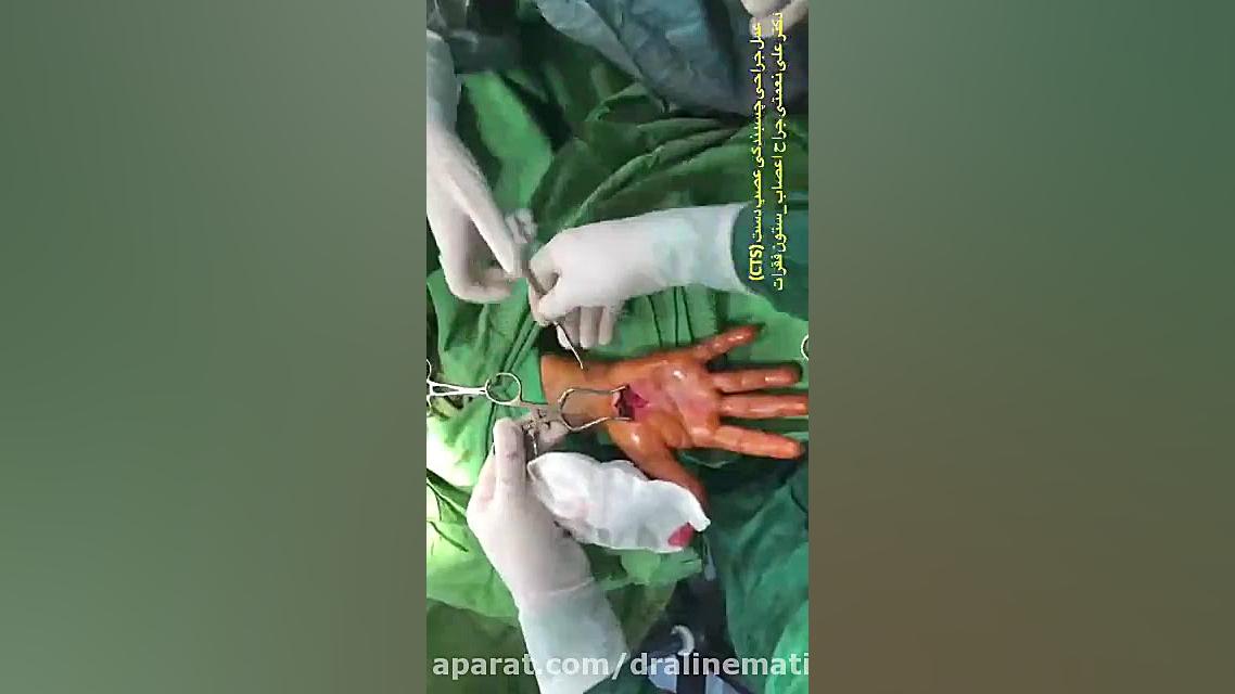 چسبندگی عصب دست ( سندرم تونل کارپال ) بلاگر