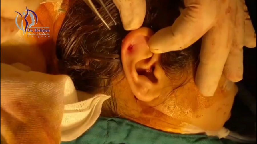 فیلم جراحی ضایعه گوشتی در محل سوراخ گوش دکتر شاهین بهجو - فوق تخصص جراحی پلاستیک